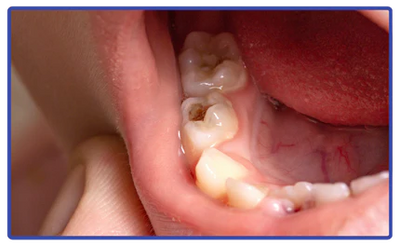 Tandgezondheid bij kinderen